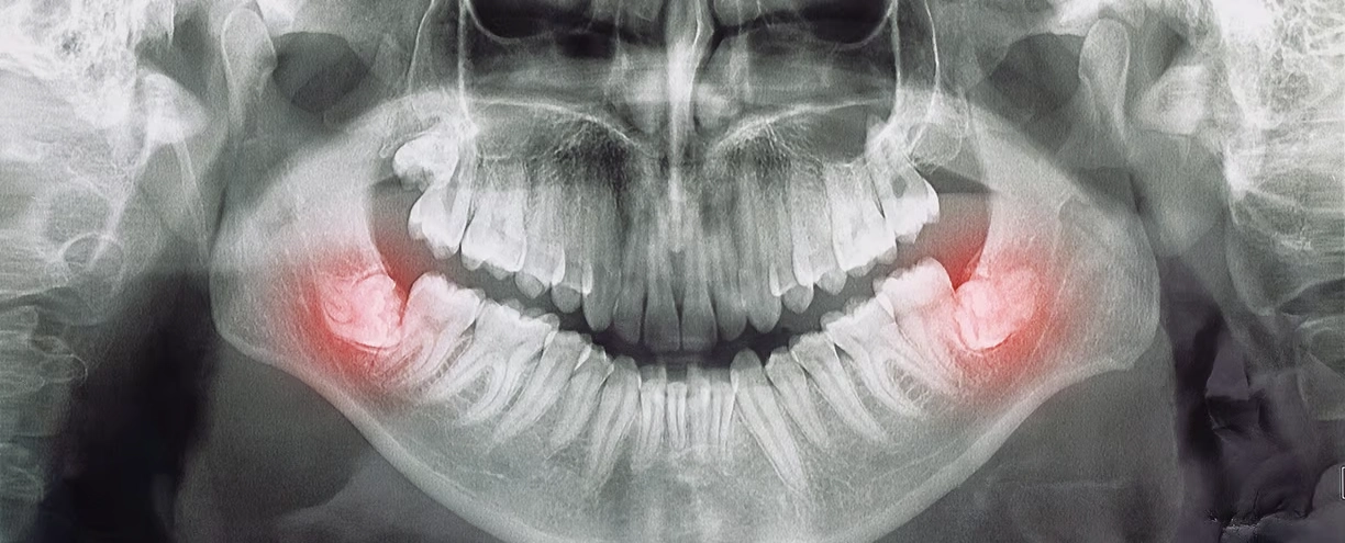 Here's an alt tag for the image: Jaw x-ray showing impacted wisdom teeth.
